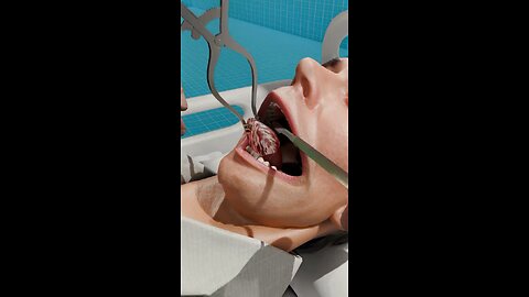 He Lost 90% of His Tongue!!