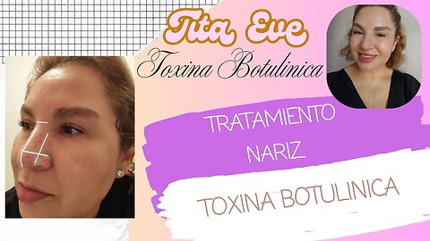 COMO APLICAR TOXINA BOTULINICA EN TODA LA NARIZ
