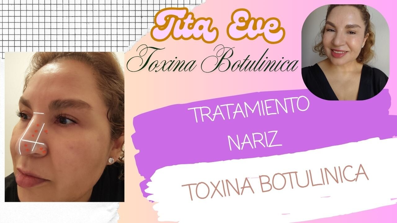 COMO APLICAR TOXINA BOTULINICA EN TODA LA NARIZ