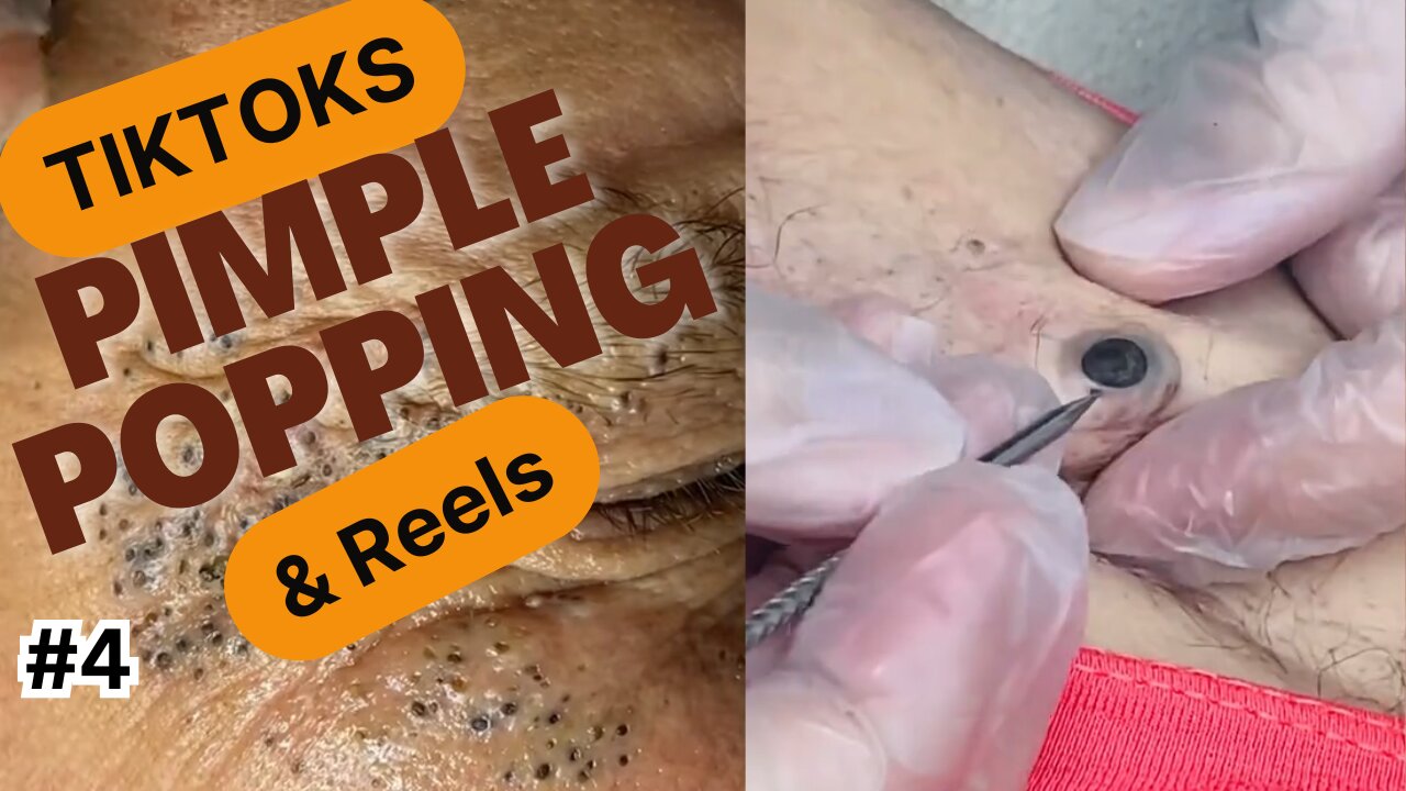 PIMPLE TIKTOKS & REELS #4
