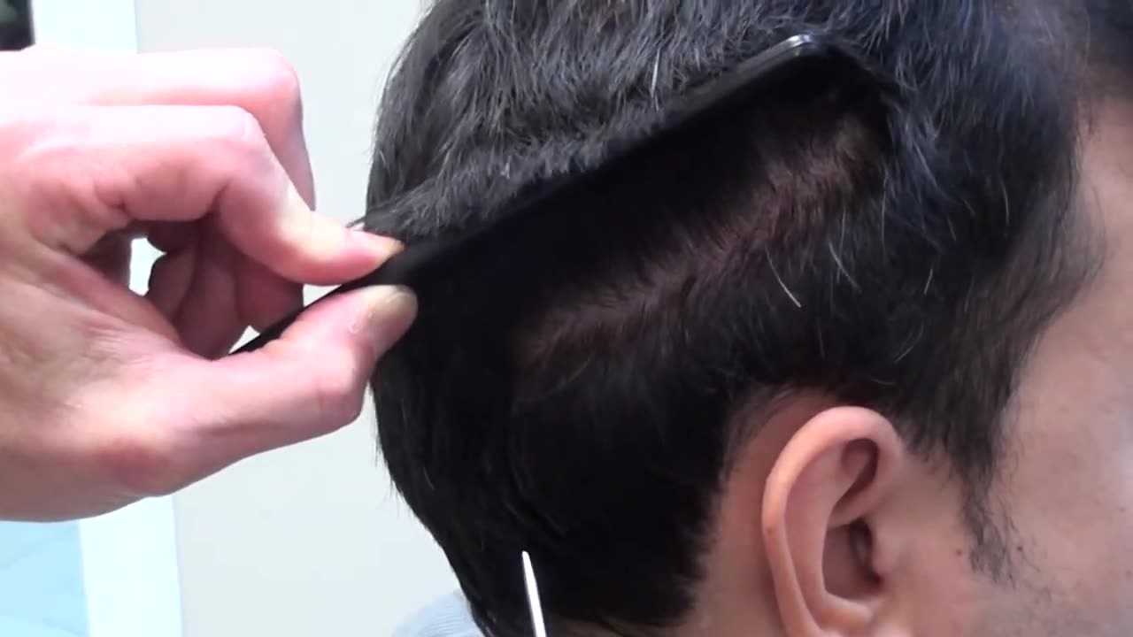 Hair Transplant Undetectable Suture Line in Only 4 Months