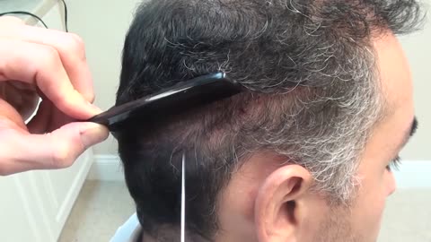 Dr. Brett Bolton | 10-Day Hair Transplant Suture Removal | Undetectable Suture Line