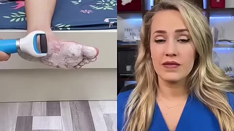 Breaking: Doctor reacts to callus shaving device