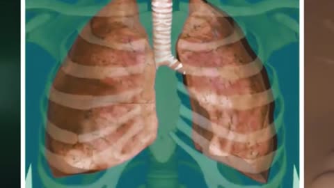 Bronchoscopy Procedure For Lung Biopsy 3D Animation