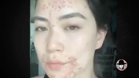 CHICKEN WING CHAMPION DESTROYED BY PFIZER DEATH JAB