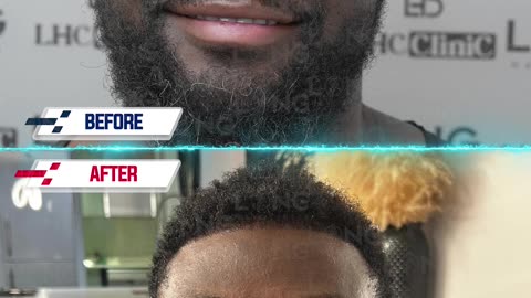 Would you have guessed that a Afro patient could transform this much after a hair transplant?