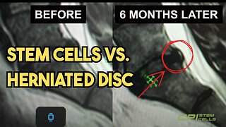 Stem Cells vs. Herniated Disc — The MRI Doesn’t Lie!