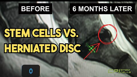 Stem Cells vs. Herniated Disc — The MRI Doesn’t Lie!