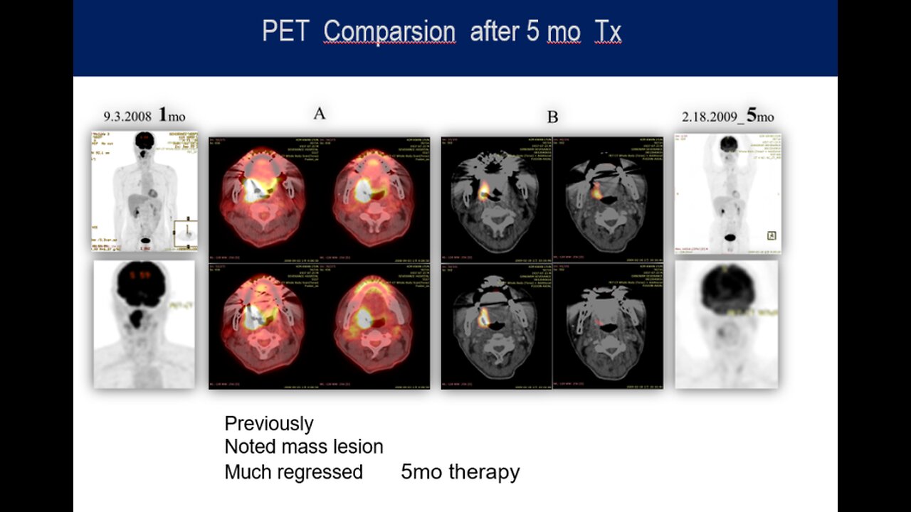 편도선암4기치료 반룡인수한의원 한태영원장님, 태음인은 소음인항암제 시스플라틴 말고 택솔을 사용해야 하는 이유, 방사선치료도 태음인만 해당