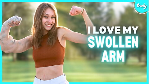 Bullies Called Me ‘The Hulk’ - But I Love My Swollen Arm | BORN DIFFERENT 