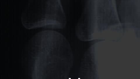 Scientific Accidents — Entry #2: X‑Rays