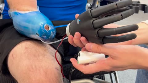 👨‍⚕️🛠️ Ukraine Russia War | A Prosthetist's Journey | RCF