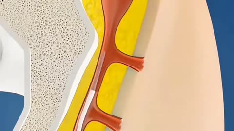 Laser Surgery for Pilonidal Sinus. Fast, Painless & Permanent Solution Explaine