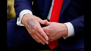 Trump Explains Mysterious Hand Bruising — Then Drops a Surprising Aspirin Admission