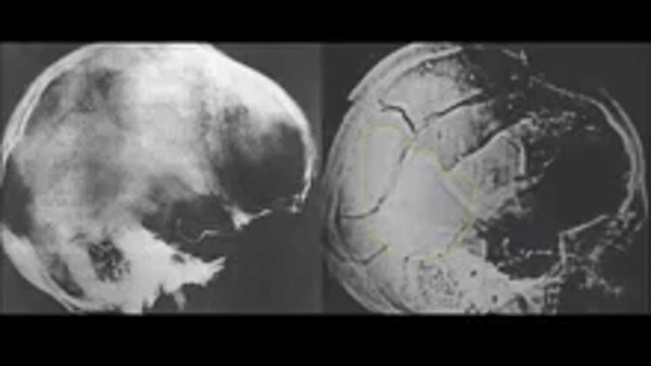 Dr. Chesser- IMPORTANT Additional findings regarding the JFK Autopsy X-Rays