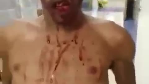 Zombie man in Brazilian Hospital