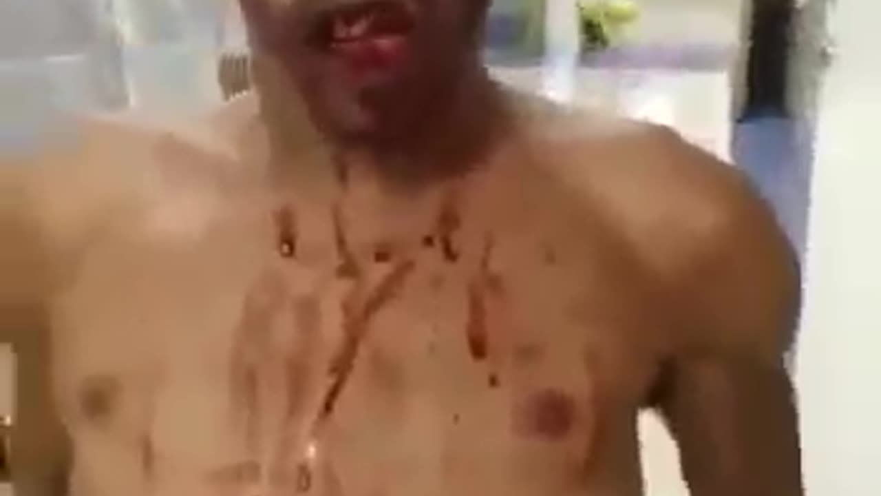 Zombie man in Brazilian Hospital