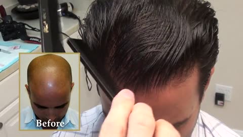 Dr. Brett Bolton | Undetectable Hair Transplant Scar – Must See Results
