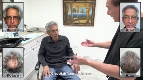 Ira’s MaxHarvest™ Plus Hair Transplant by Dr. Brett Bolton
