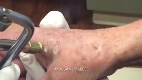 Treating age spots liver spots on the hands For medical education NSFE