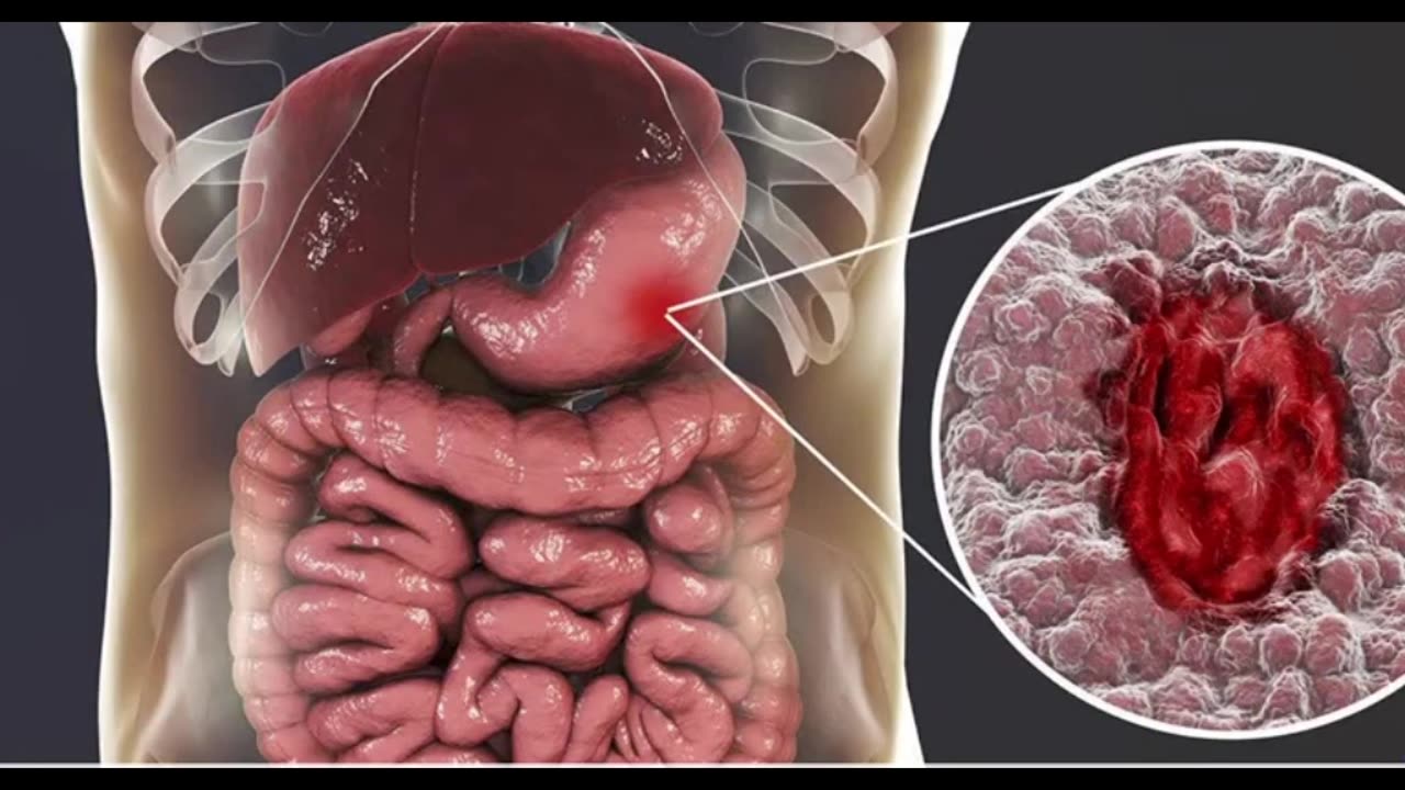 Are Spicy Takis Bad for Your Stomach Let’s Break It Down