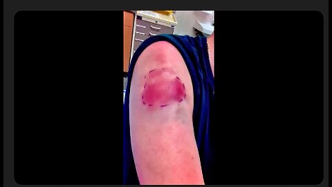 THIS ONE IS OFF THE CHARTS: 45 surgeries got a Frankenshot-they are turning him into a zombie🧟‍♂️