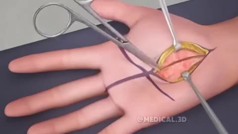 Carpal Tunnel Release Surgery (3D Animation)
