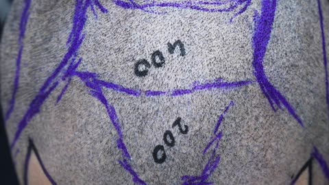 Where your new, natural-looking hairline begins.