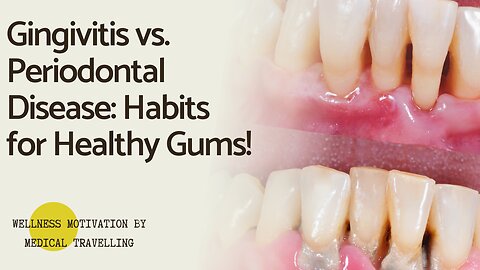 Gingivitis vs. Periodontal Disease: Habits for Healthy Gums!