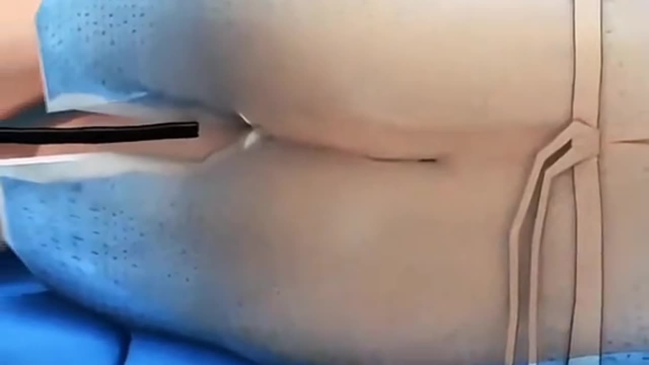 Colonoscopy Procedures Is Done