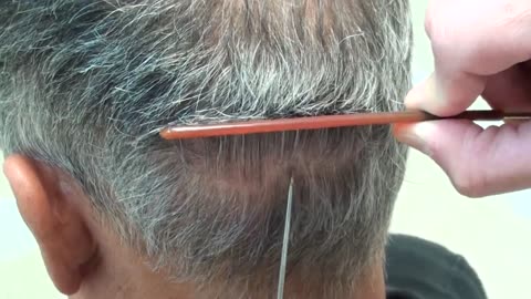 Amazing Hair Transplant Scar | Dr. Brett Bolton Results