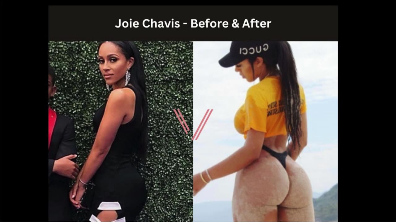 Joie Chavis Brazilian Butt Lift, BBL.