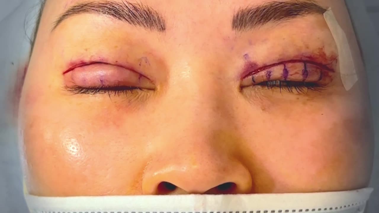 Surgery Completed: Precision in Awake Double Eyelid Surgery with Dr. Kenneth Kim