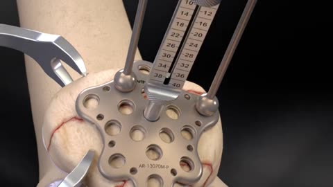 Patella Fracture Repair 3D Animation