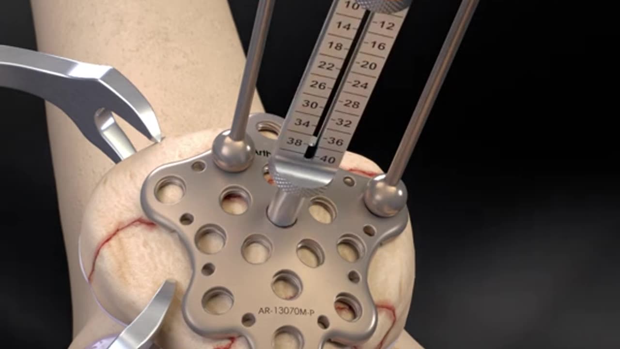 Patella Fracture Repair 3D Animation