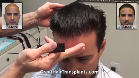 Dr. Brett Bolton: Undetectable Hair Transplant Scar – Incredible Results!