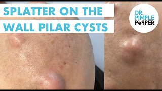 Splatter on the Wall Pilar Cysts