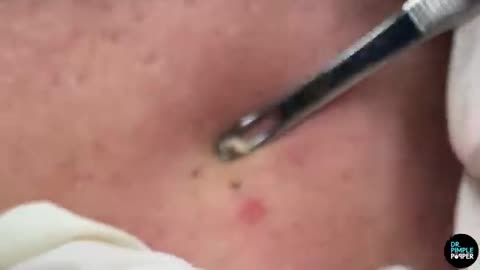 To Blackheads Beyond