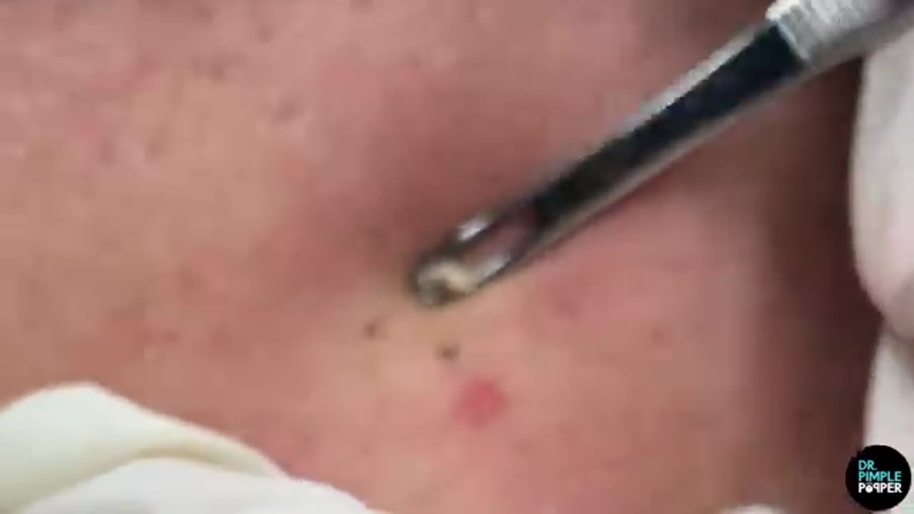 To Blackheads Beyond