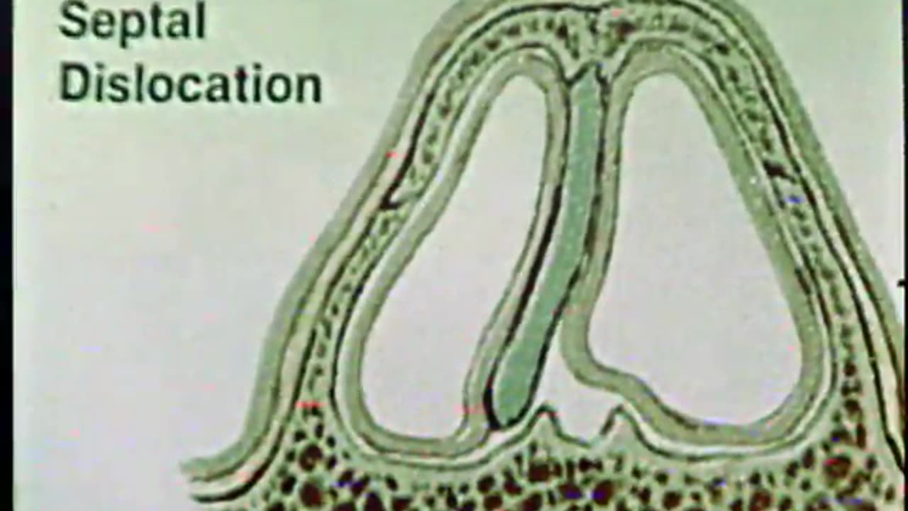 NOSE AND SIN... - NOSE AND SINUS CLINICAL PROCEDURES - PART II - NASAL FRACTUR - gov.dod.dimoc.32618