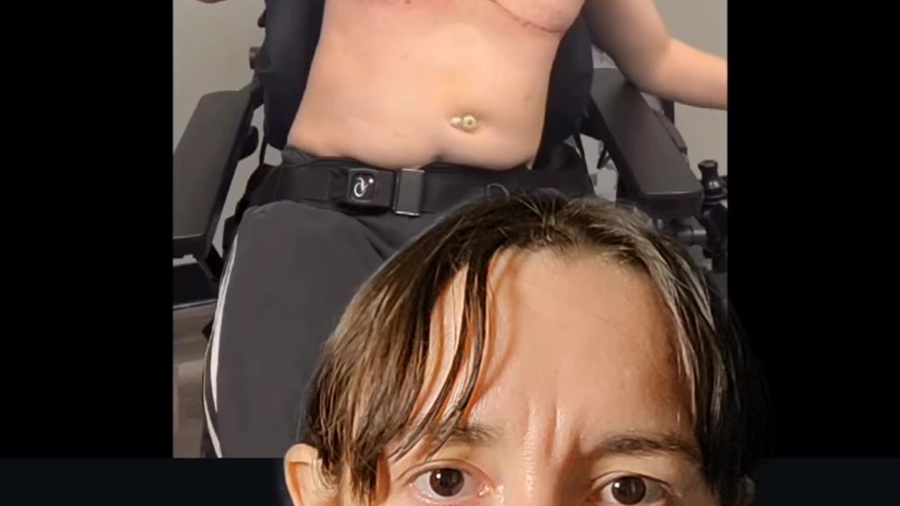 Mastectochism: Woman with Cerebral Palsy Loses Nipples