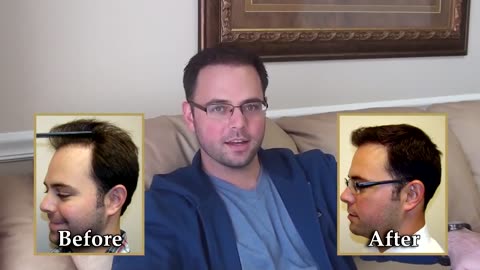 Dr. Brett Bolton Fixes a Previous Hair Transplant with Unbelievable Results