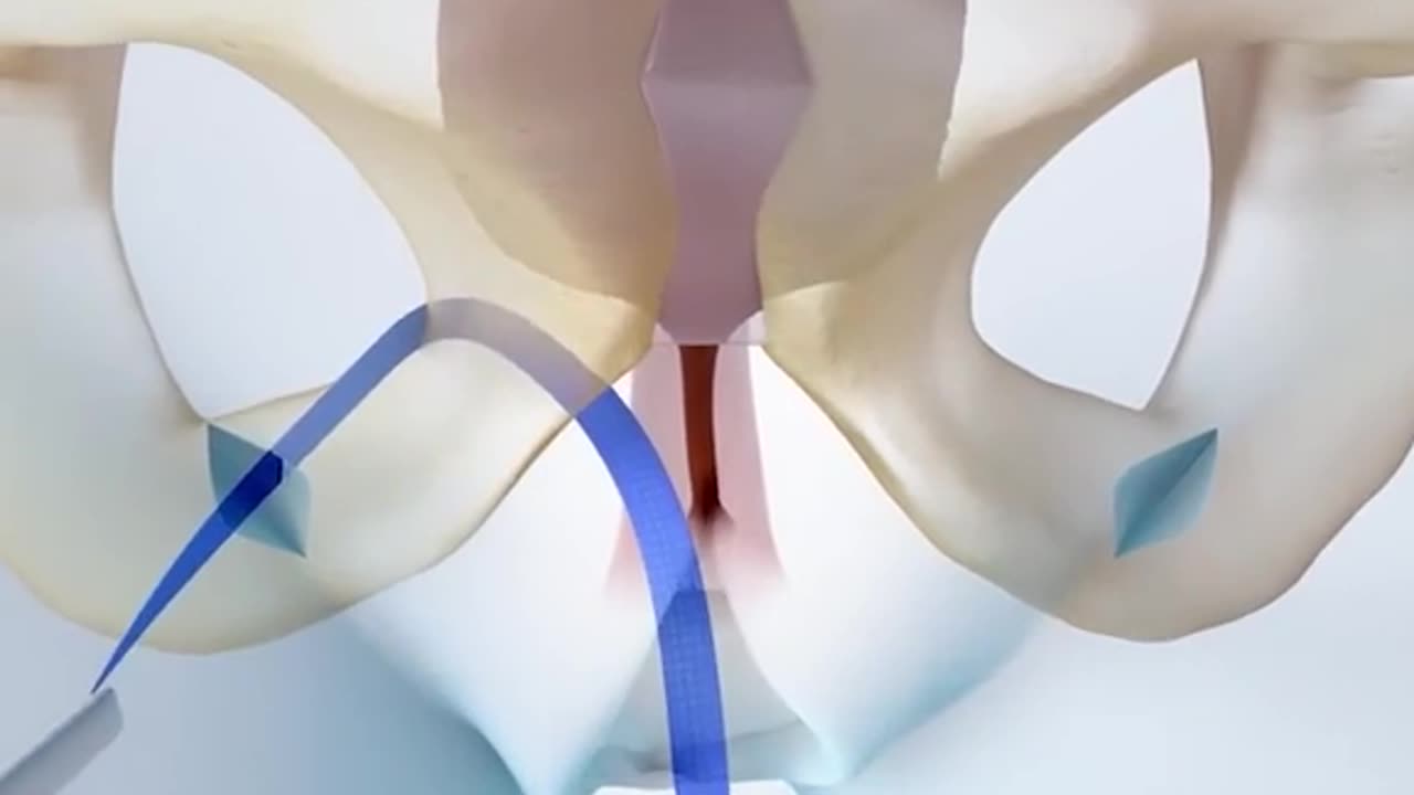 Tension Free Vaginal Tape Insertion 3D Animation (TVT)