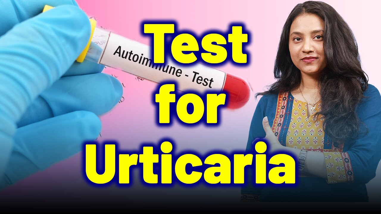 Important Test for Urticaria, Nettle rash, Hives, Wheals . | Treatment Cure | Homeopathy