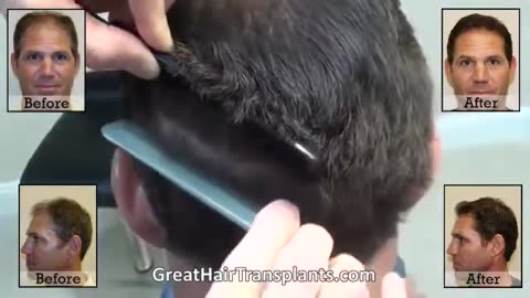 Unbelievable Hair Transplant Outcome in 7 Months by Dr. Brett Bolton