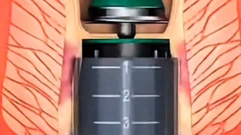 Advanced Hemorrhoid Surgery Explained 🔥 Modern Treatment for Piles Relief