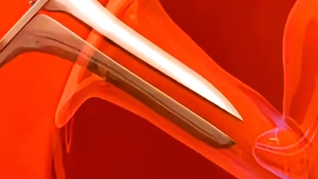 This Tiny Device Can Prevent Pregnancy for Years — Here’s How It Works!