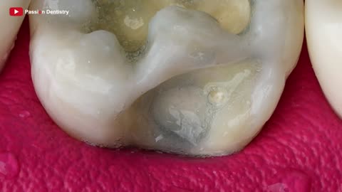 Incredible Work By Failure And Demotivated Dentist _ Artistic Tooth Restoration