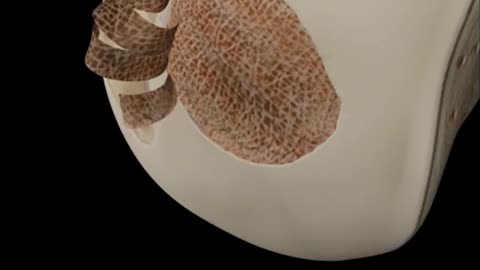 Cartilage Abrasion Microfracture Treatment 3D Animation