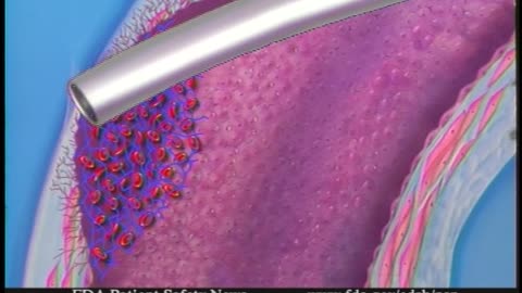 FDA Patient Safety News (Februa... - FDA Patient Safety News (February 2002) - gov.ntis.ava21054vnb1